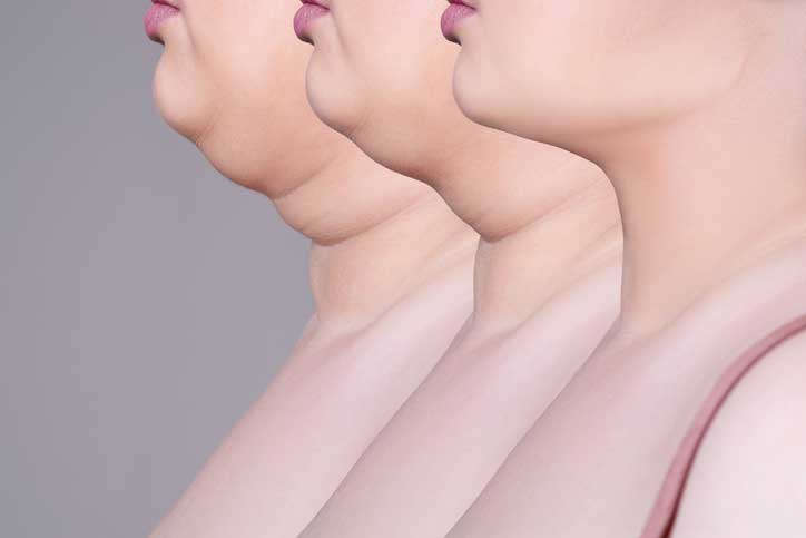 Kybella FAQs