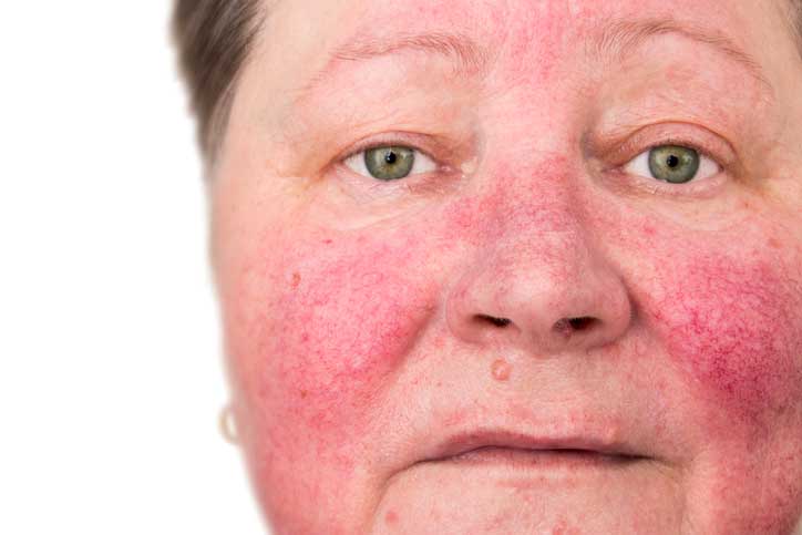 Common Rosacea Triggers