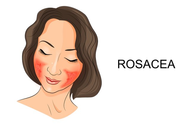 Illustration of a women,Rosacea