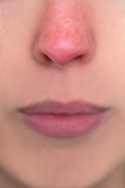 ROSACEA