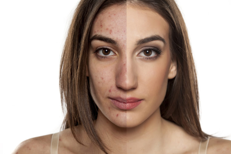 Comparison portrait of a woman with problematic skin without and with makeup