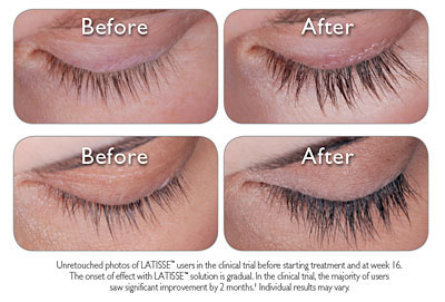 Eyelashes Before and After Preview