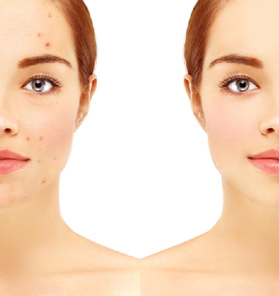 Before and after image of woman face