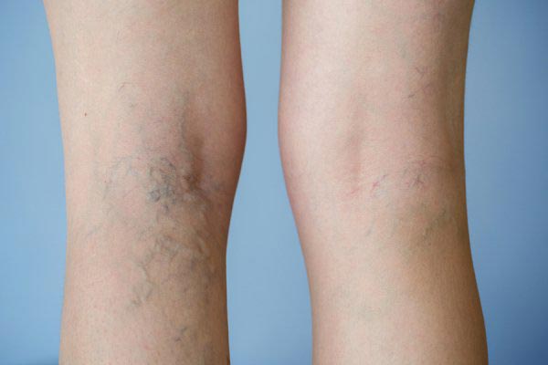 Before after image of spider veins