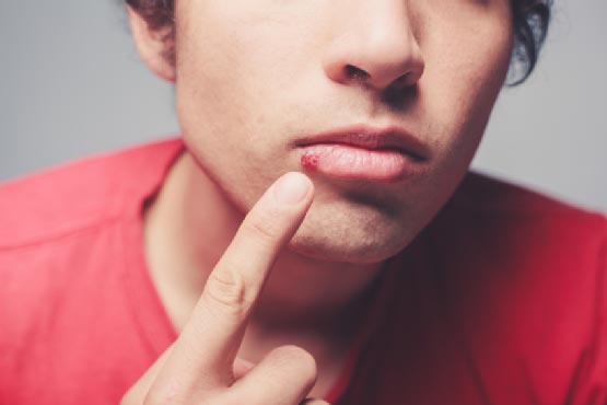 Young man with cold sore