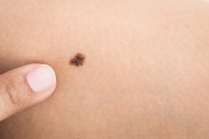 Melanoma on skin