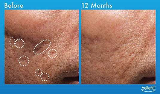 Bellafill before and after image from Swinyer-Woseth Dermatology