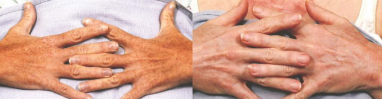 Hand Rejuvenation before and after