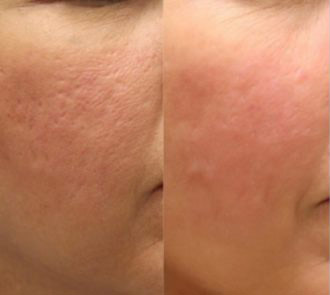 Platelet Rich Plasma (PRP) + Microneedling before and after