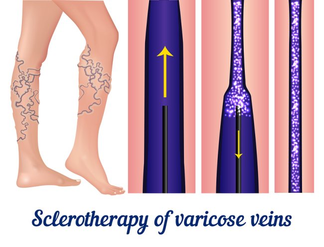 Sclerotherapy of varicose vein