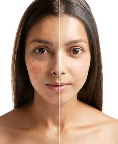 Chemical peels from a dermatologist