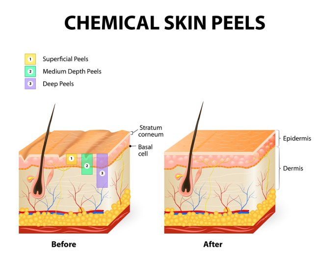 Illustration of chemical skin peels