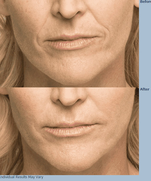 Belotero before and after image from Swinyer-Woseth Dermatology