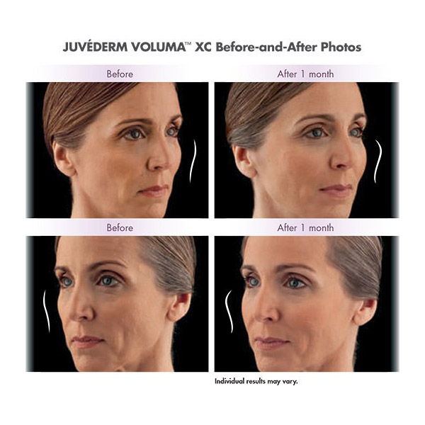 juvederm voluma before and after