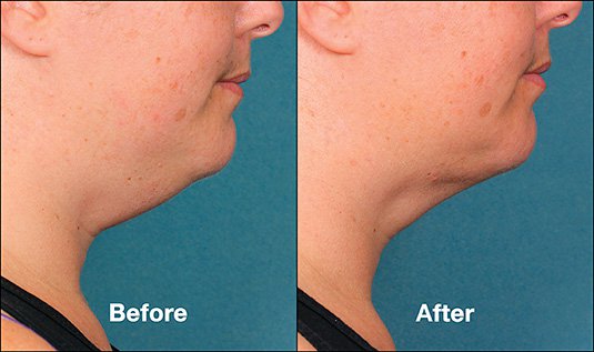 Kybella before and after in Salt Lake City