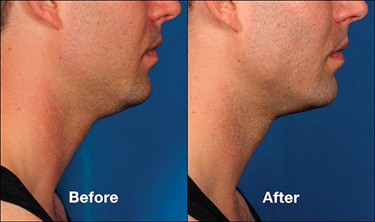 Kybella before and after image from Swinyer-Woseth Dermatology