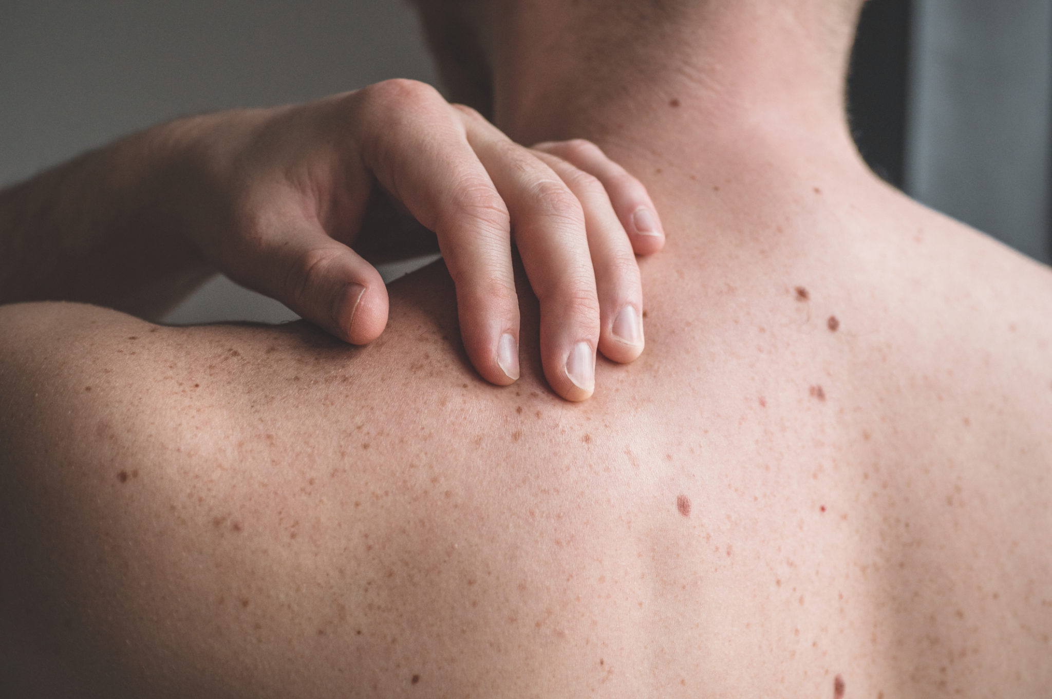 Understanding The Moles On Your Skin Swinyer Woseth Dermatology