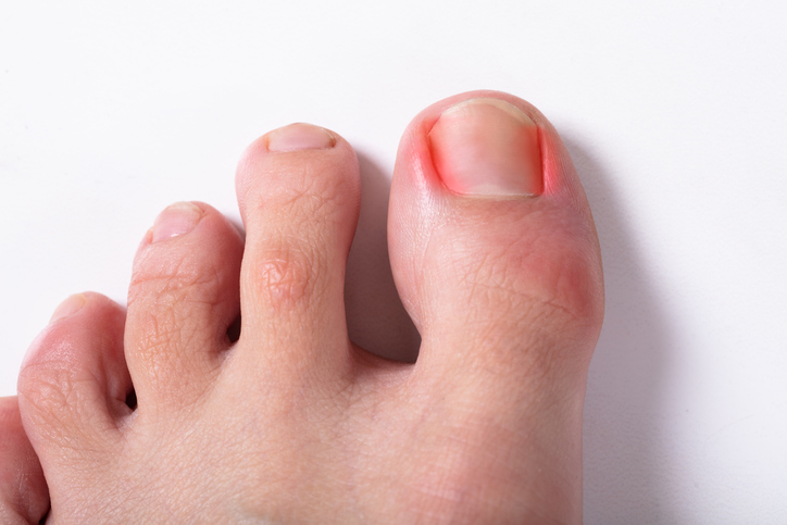 Ingrown nail - Wikipedia