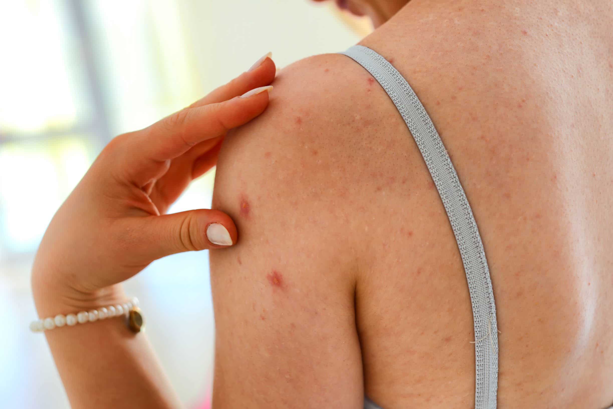 Back acne treatment in Salt Lake City, South Jordan