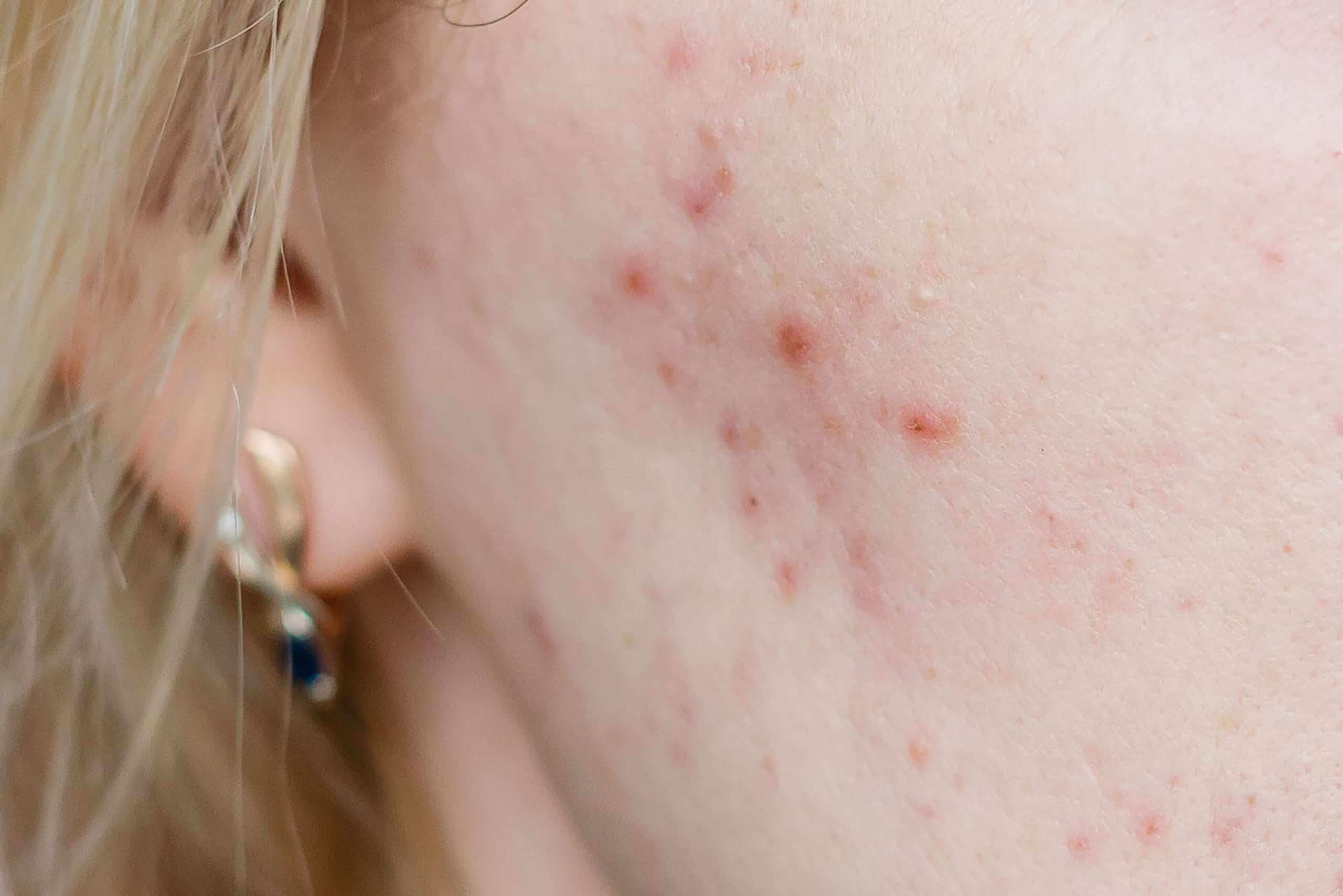 Cystic acne treatment in Salt Lake City, South Jordan