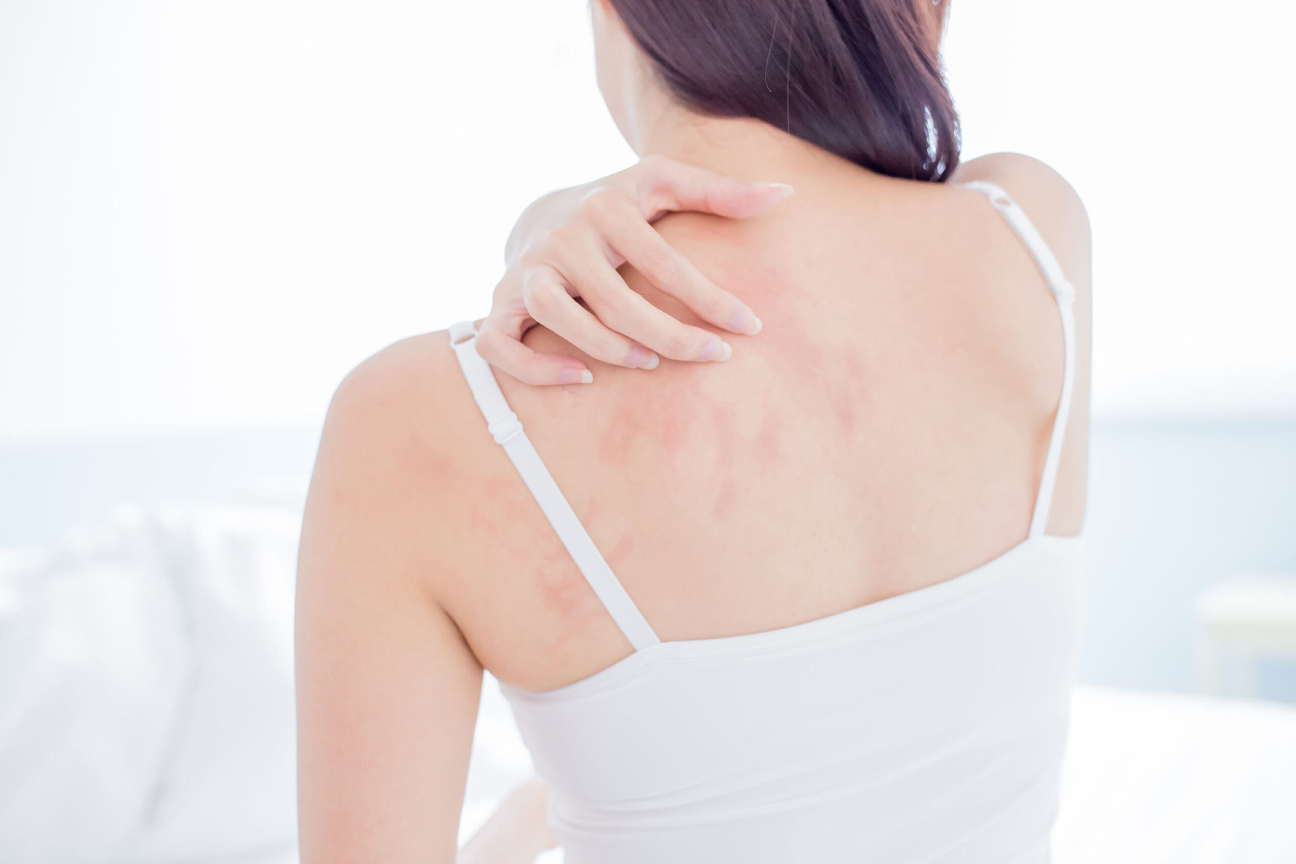 Skin rashes treatment in Salt Lake City, South Jordan