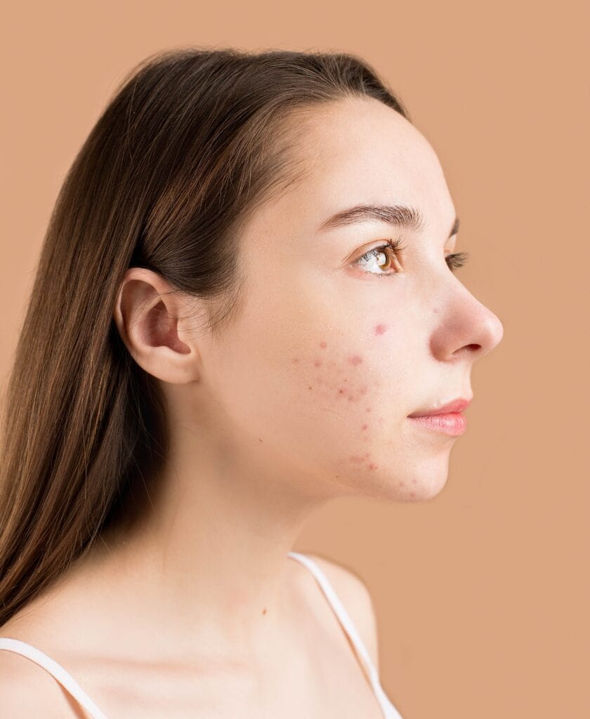 How to manage adult acne in Salt Lake City, UT