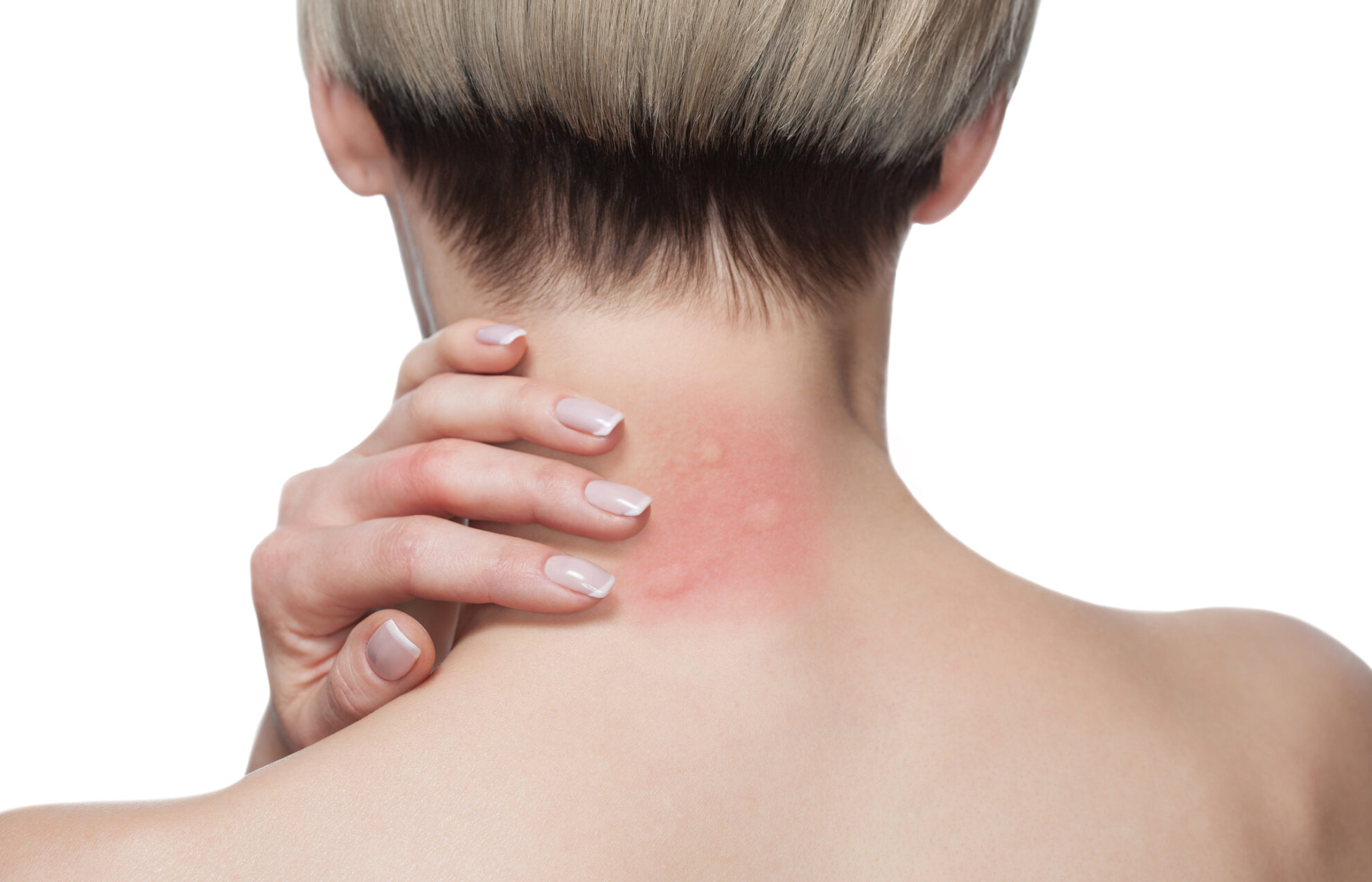 Checkbox Rash What's That Rash? | Swinyer Woseth Dermatology