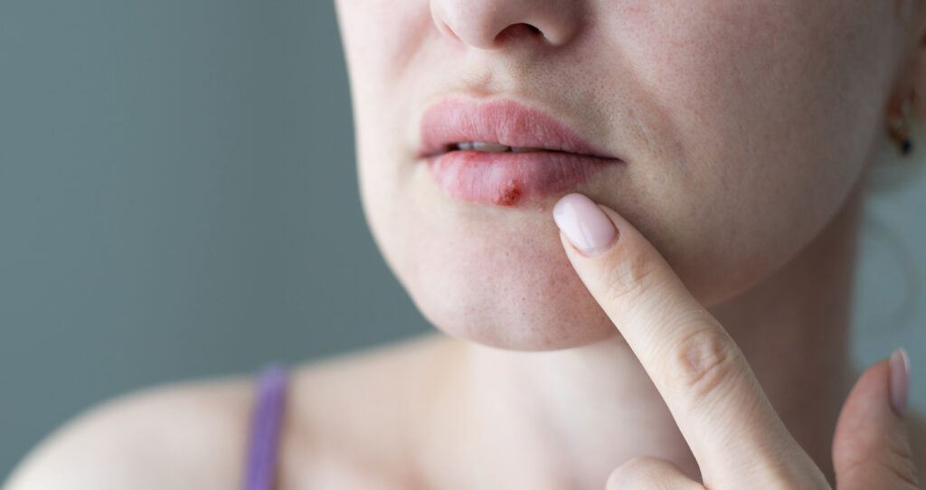 Cold Sores Treatment by Swinyer-Woseth Dermatology