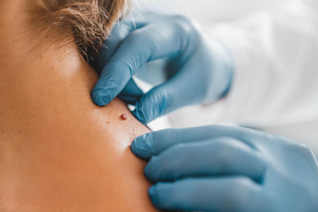 Innovative mole treatments at Swinyer Woseth Dermatology, Salt Lake City, and South Jordan.