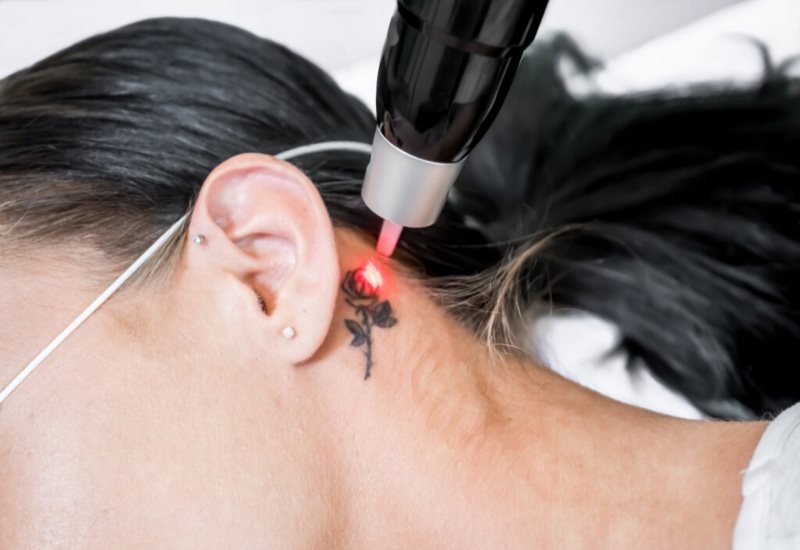 Laser Tattoo Removal