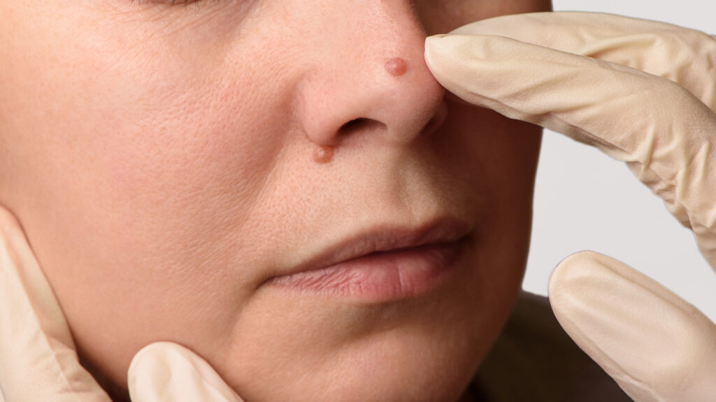 Warts skin treatments by Swinyer Woseth Dermatology in Salt Lake City and South Jordan.