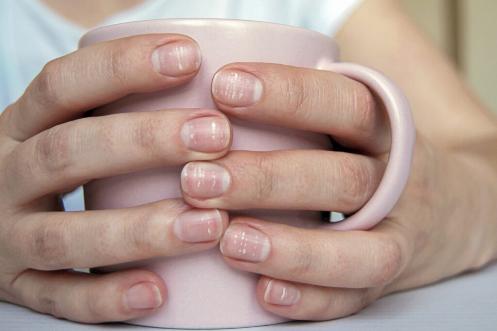 Get Healthy Nails Get Healthy Nails with Swinyer Woseth Dermatology