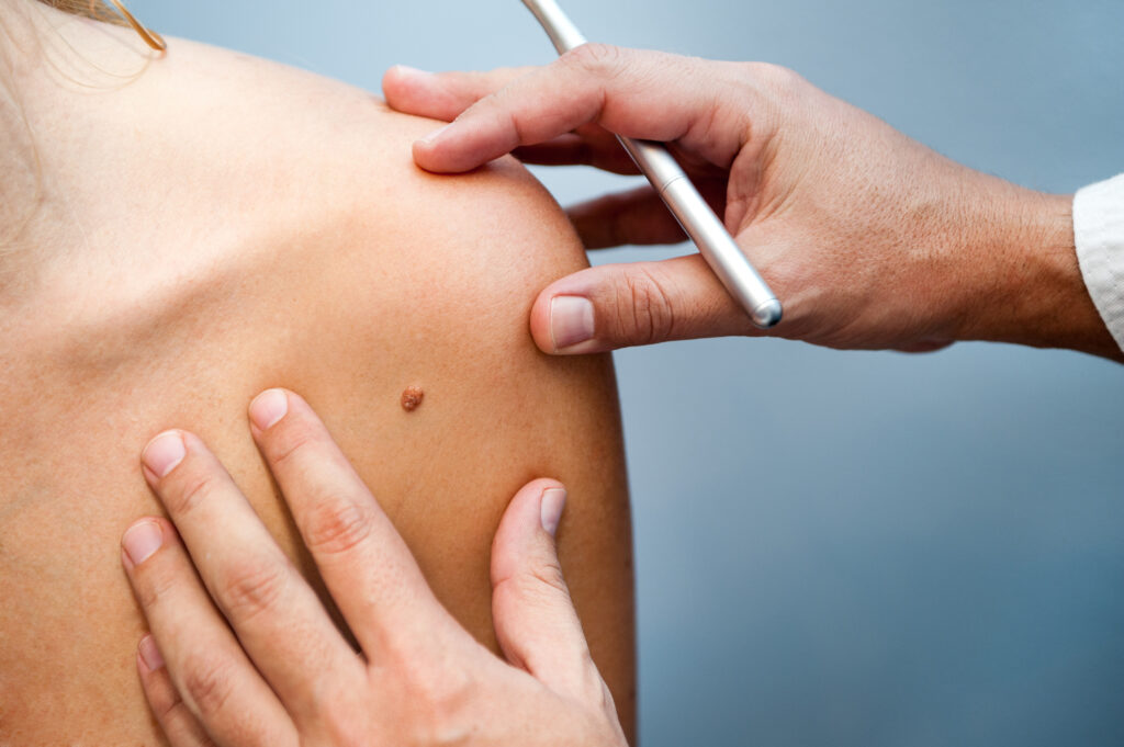 Skin Cancer Treatment in Salt Lake City