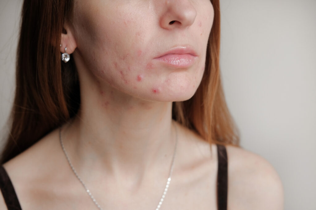 Acne Treatment in Salt Lake City & South Jordan, UT