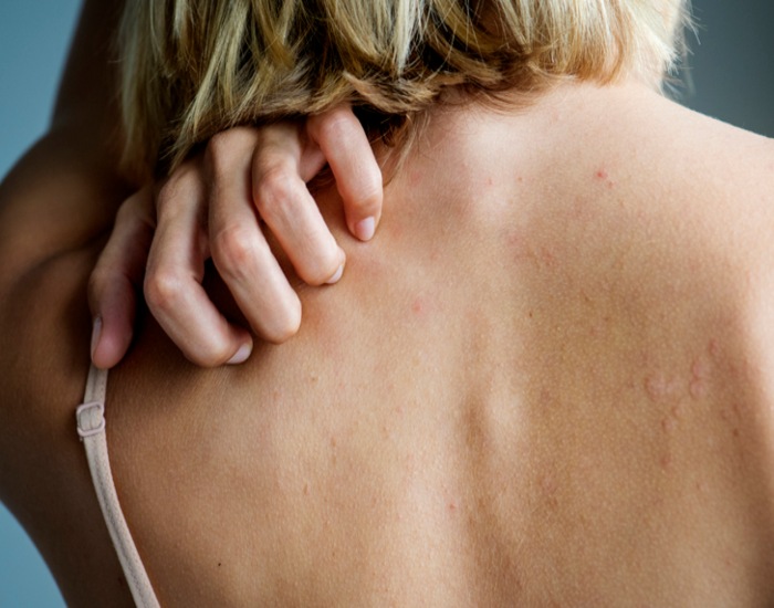 Rashes Treatment in Salt Lake City, South Jordan