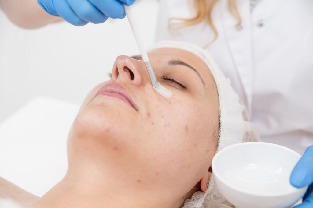 Chemical Peel for Acne Pro Skin