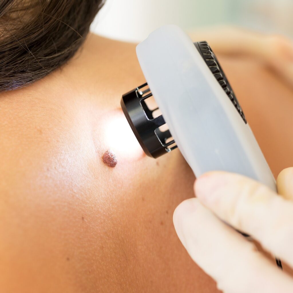 Skin Cancer Screening in Salt Lake City & South Jordan, UT