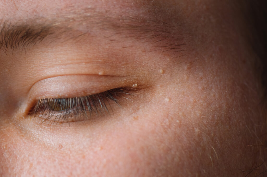 Close-up of small white bumps around the eyelid and upper cheek area