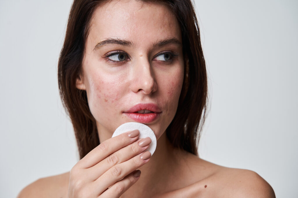Acne Treatment in Salt Lake City