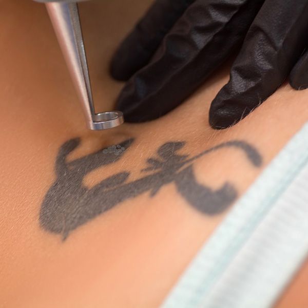 Tattoo Removal Treatment in San Diego CA with the New RESONIC Device   YouTube