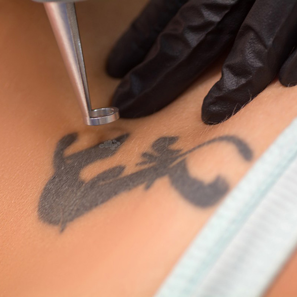 Tattoo Removal by Swinyer - Woseth Dermatology