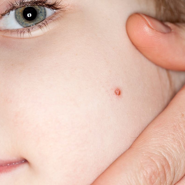 Warts Treatment by Swinyer - Woseth Dermatology