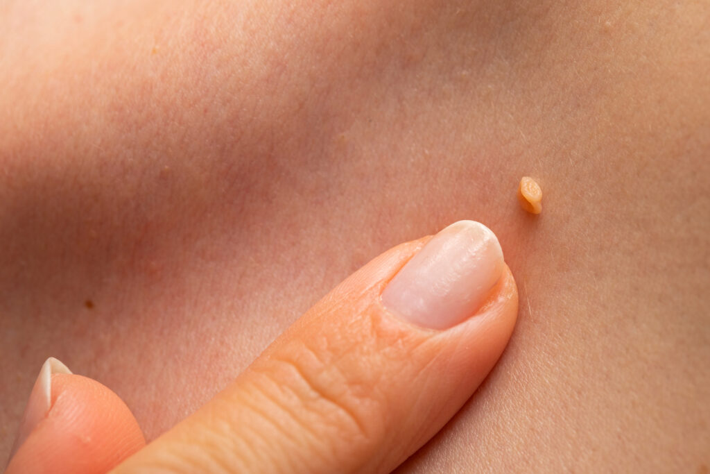 Warts procedures to enhance skin health in Salt Lake City & South Jordan, UT.
