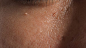 Skin Tags Treatment in Salt Lake City