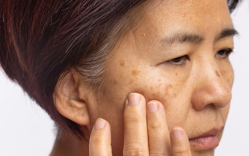 Melasma Treatment in Salt Lake City & South Jordan
