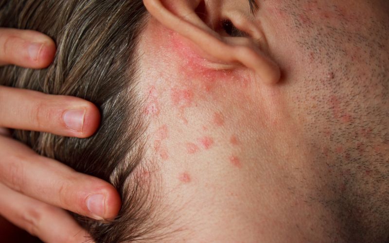 Psoriasis Treatment in Salt Lake City & South Jordan
