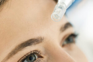 Micro Needling Process in South Jordan