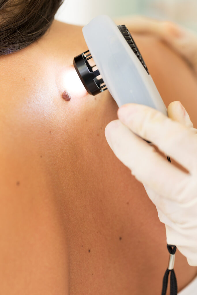Skin cancer screening by Swinyer Woseth Dermatology in Salt Lake City and South Jordan.
