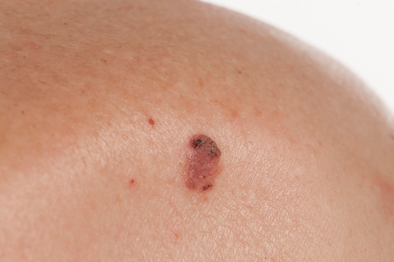 A close-up of basal cell carcinoma on a shoulder by Swinyer Woseth Dermatology