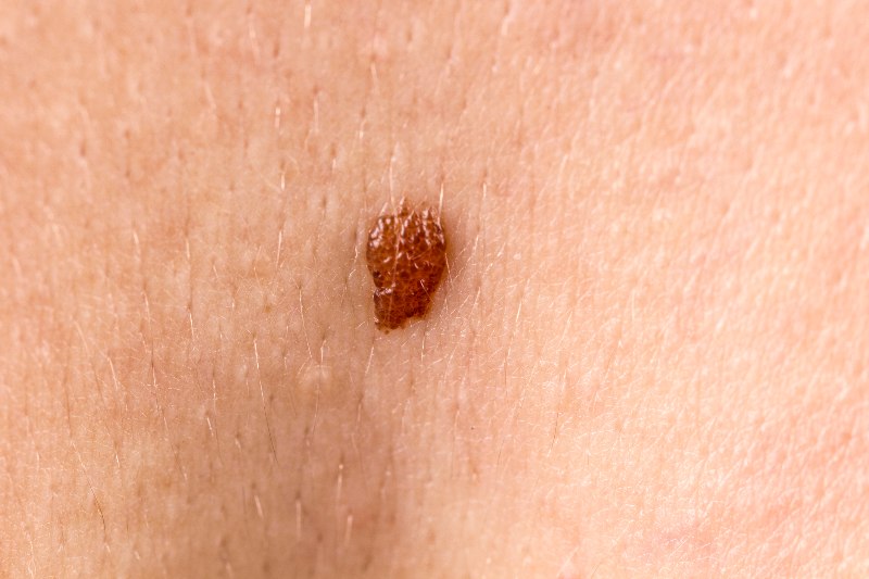 A close-up of a mole that is being looked at for cancer by Swinyer Woseth Dermatology